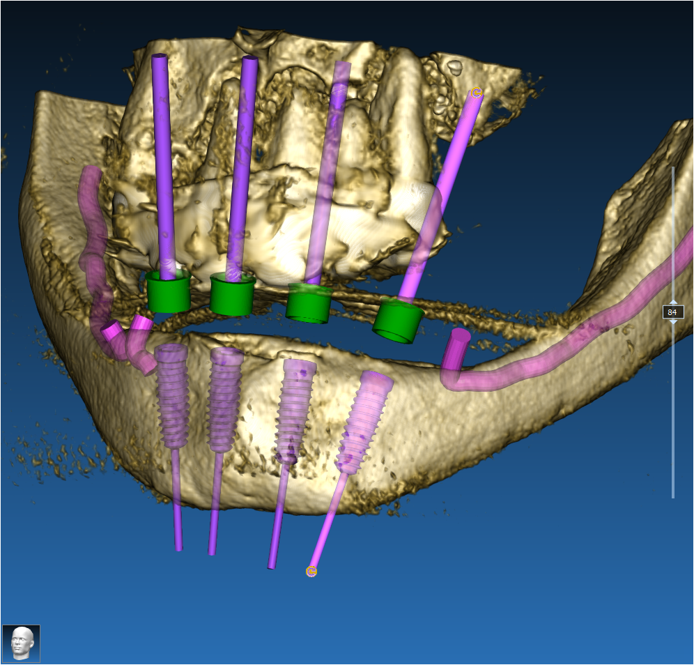 Chirurgia Implantare Guidata